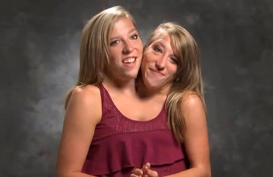 Conjoined Twins Abby and Brittany Featured on TLC